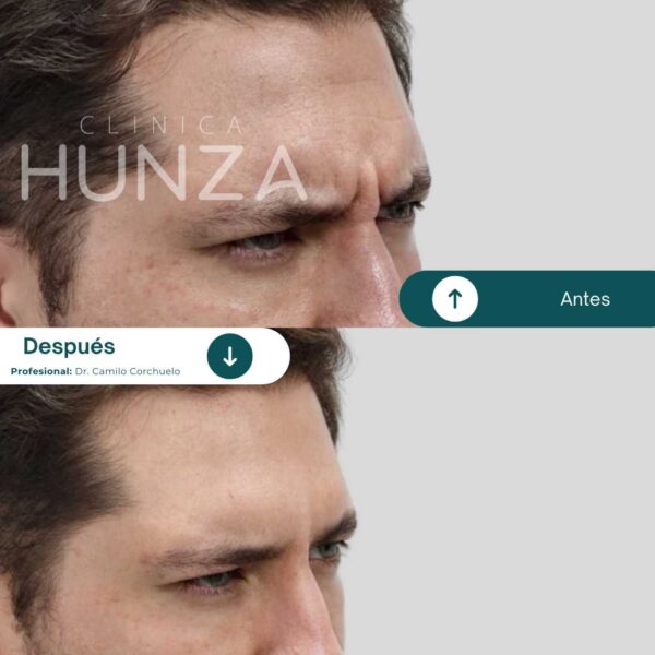 Infiltración de Toxina Botulínica (Botox) 3 zonas Tercio Superior + Limpieza Facial - Imagen 3