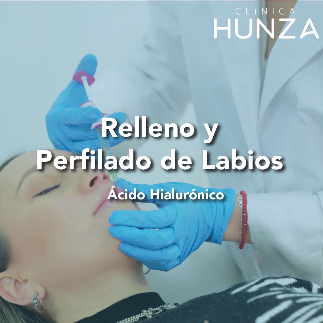 Relleno y Perfilado de Labios - Acido hialurónico