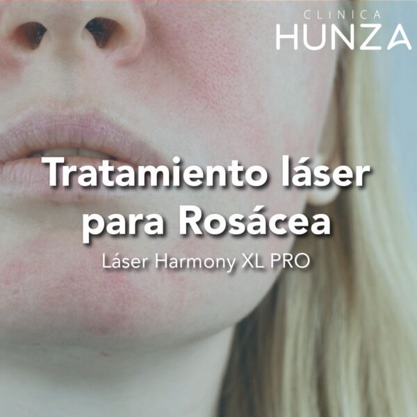 Tratamiento Láser para Rosacea