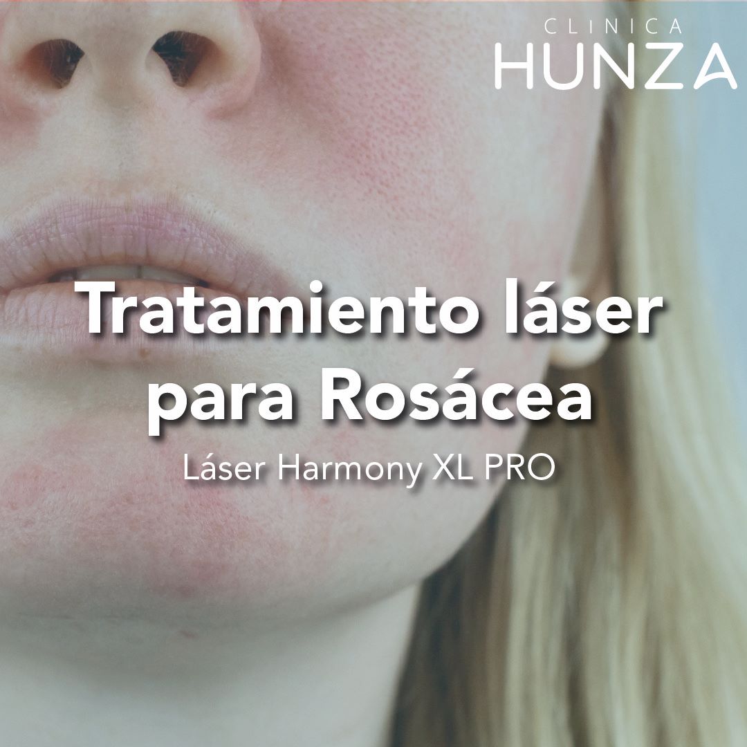 Tratamiento Láser para Rosacea