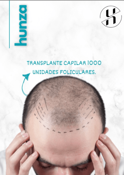 Transplante Capilar