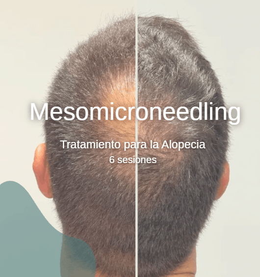 MESOMICRONEEDLING ALOPECIA (6s)
