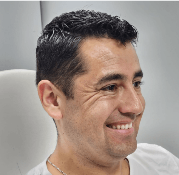 Infiltración de Toxina Botulínica (Botox) 3 zonas Tercio Superior + Limpieza Facial - Imagen 8