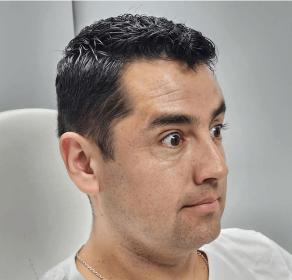 Infiltración de Toxina Botulínica (Botox) 3 zonas Tercio Superior + Limpieza Facial - Imagen 6