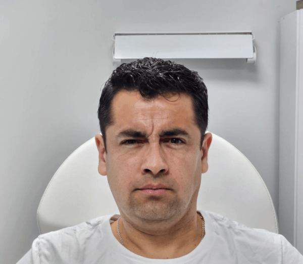 Infiltración de Toxina Botulínica (Botox) 3 zonas Tercio Superior + Limpieza Facial - Imagen 4