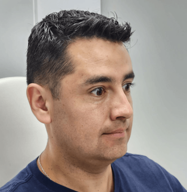 Infiltración de Toxina Botulínica (Botox) 3 zonas Tercio Superior + Limpieza Facial - Imagen 7