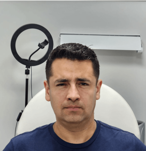 Infiltración de Toxina Botulínica (Botox) 3 zonas Tercio Superior + Limpieza Facial - Imagen 5