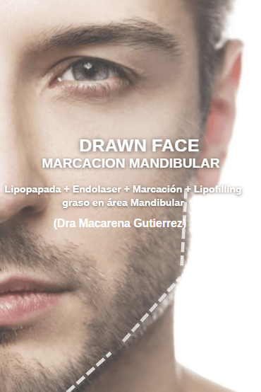DRAWNFACE Marcación Mandibular (Dra Macarena Gutierrez)