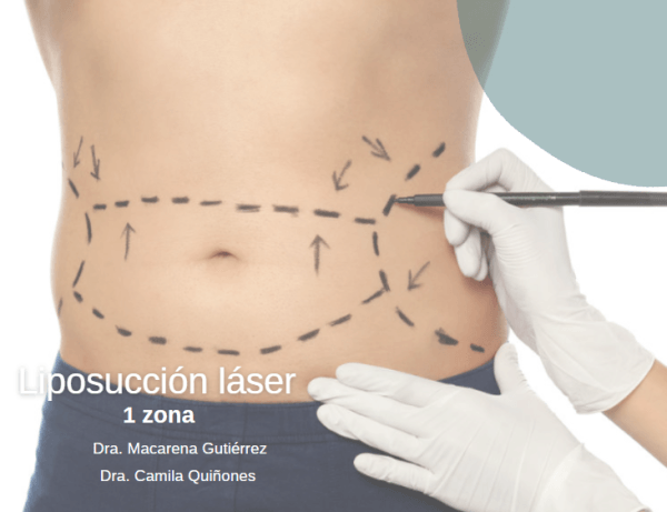Liposucción Láser Ambulatoria 1 zona ( Abdomen Completo ó Flancos ó Pectorales (solo Lipomastia)