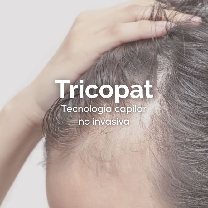 Tricopat - Tecnología capilar no invasiva