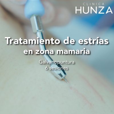 Estrías en zona mamaria