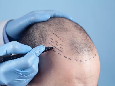 Patient suffering from hair loss in consultation with a doctor. Doctor using skin marker